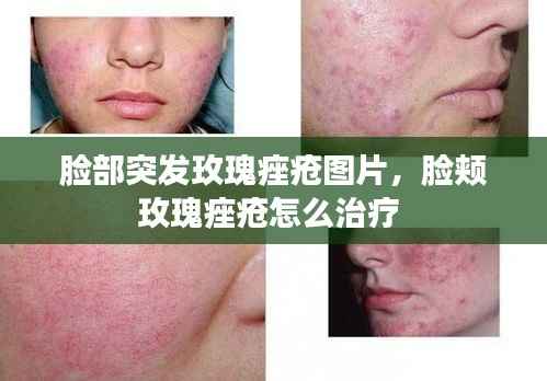 脸部突发玫瑰痤疮图片,脸颊玫瑰痤疮怎么治疗